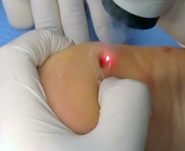 使用激光去除脚后跟疣的过程